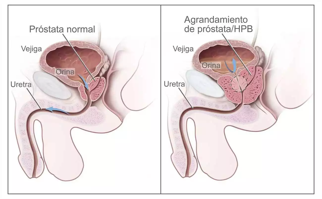 Prostamin en Almería: Encuentra la solución natural para la salud de la próstata